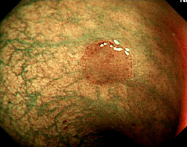 大腸内視鏡検査と同時に日帰り大腸ポリープ切除