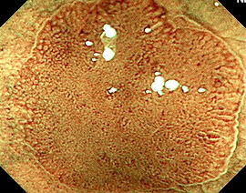 NBIと拡大内視鏡