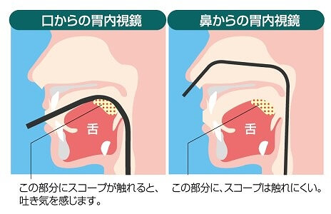 鼻から挿入する苦痛のない経鼻検査